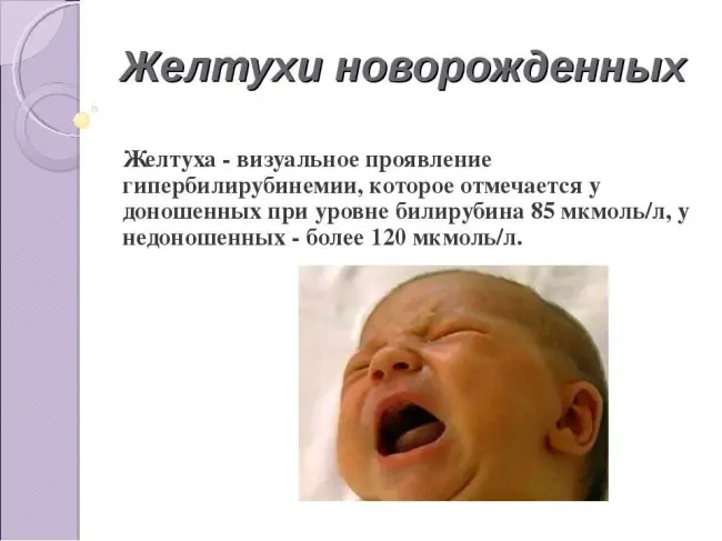 Причины возникновения желтухи новорожденных