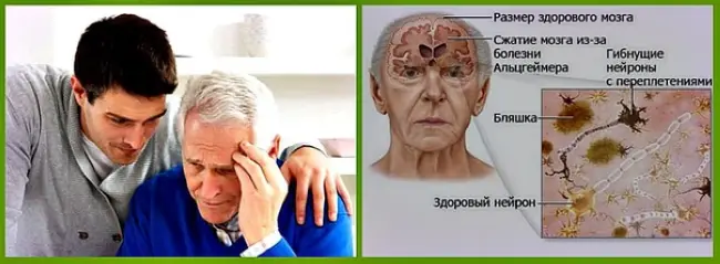 Симптомы и признаки болезни Альцгеймера